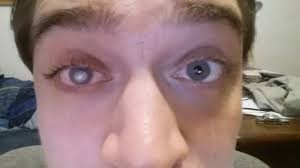 Chickenpox, shingles vaccine ups eye inflammation risk – Study