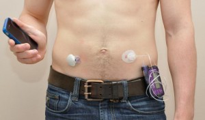 artificial-pancreas