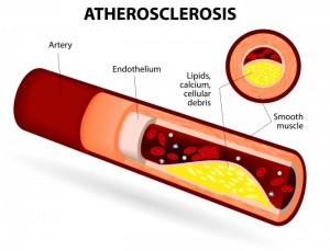 diagram-of-atherosclerosis