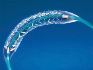 Government Slashes Prices of Stents Drastically